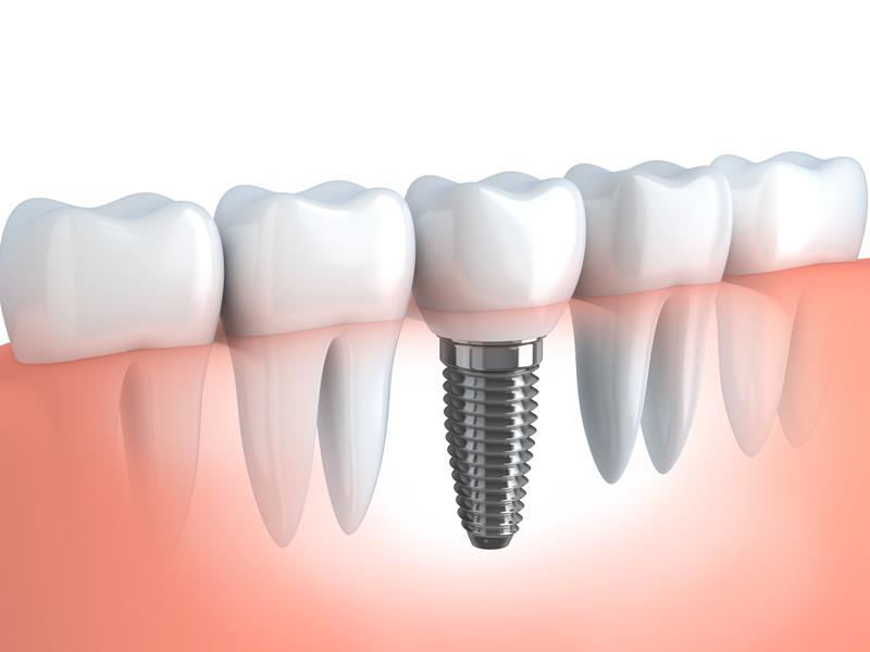 Dental Implants Sugar Grove, IL