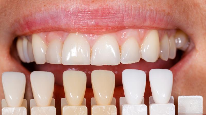 Veneers Sugar Grove, IL